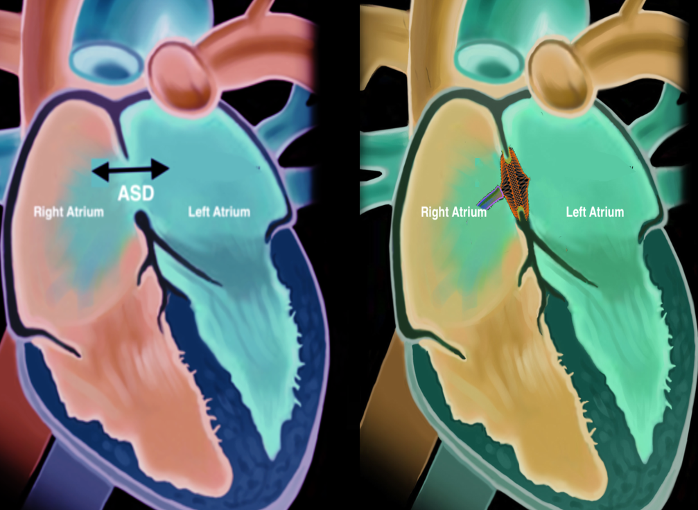 <p>Atrial Septal Defect Closure.</p>