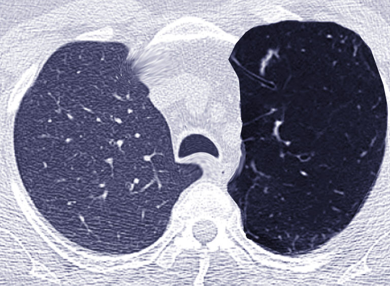 Bronchial atresia