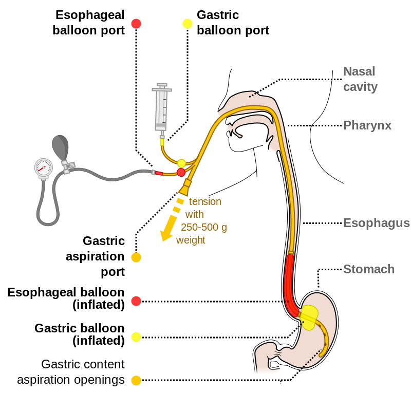 Sengstaken–Blakemore tube