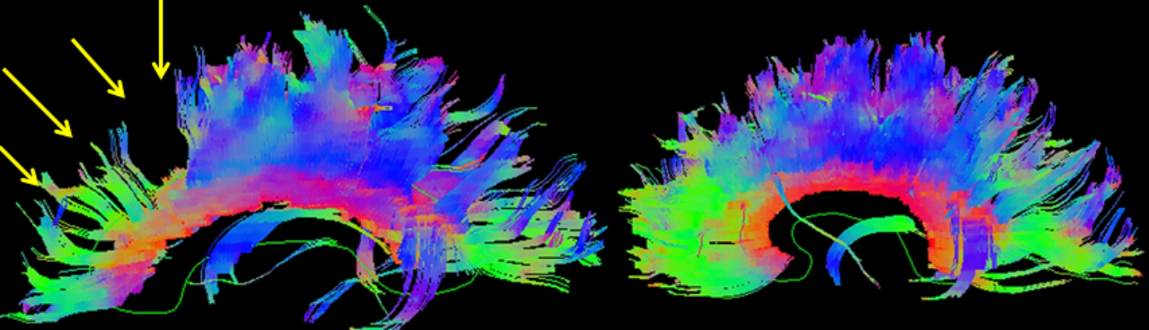 3D reconstructed DTI image on the left demonstrates marked bilateral frontal axonal thinning and fiber tract gaps in this patient with bilateral post-traumatic frontal contusions on conventional imaging