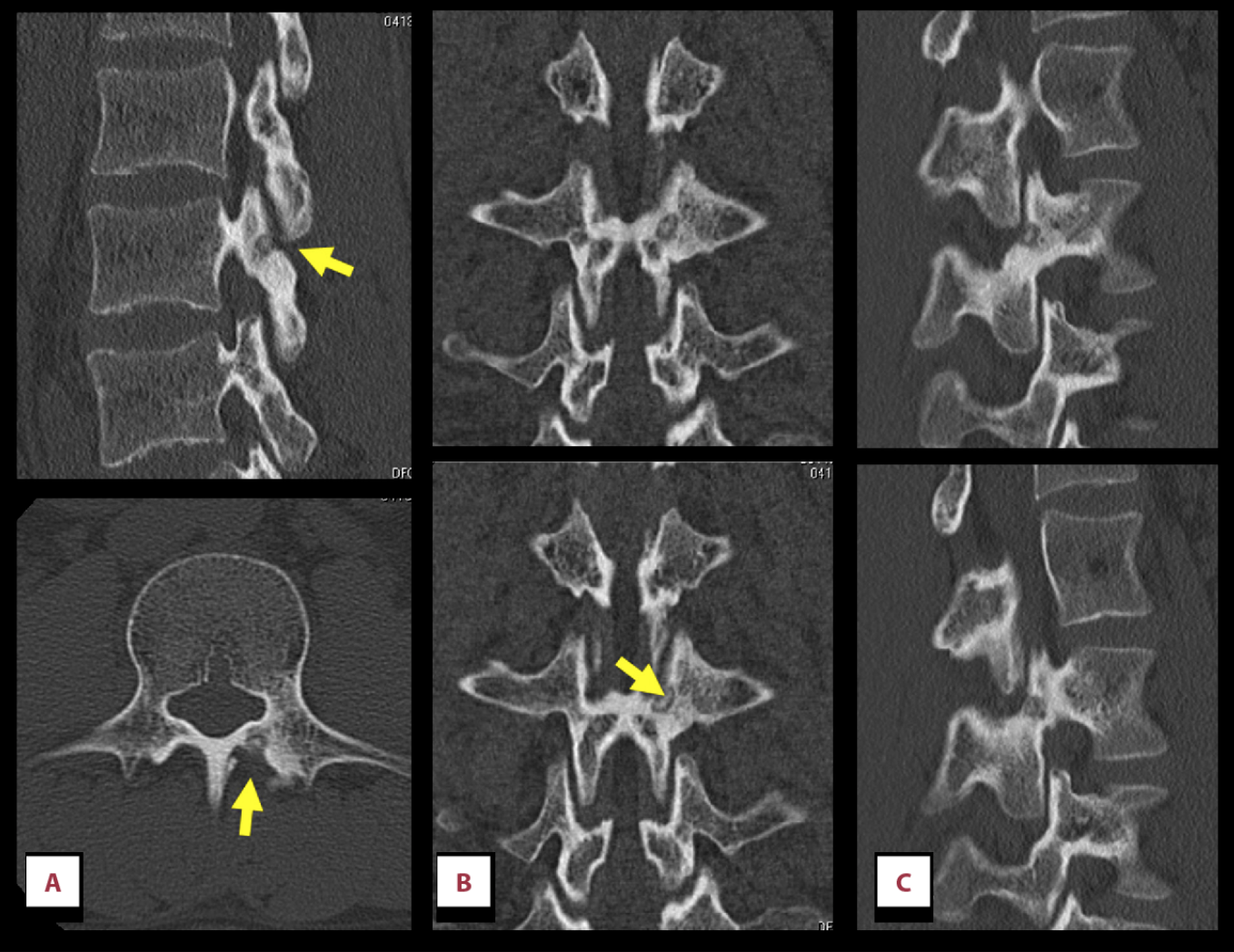 Osteoid Osteoma in the pars interarticularis resulting in pathologic fracture. Wiltse type V pars defect.