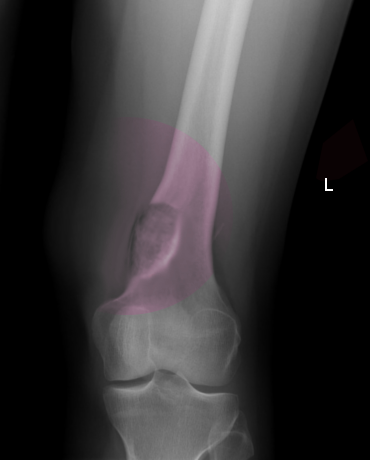 Osteoblastoma