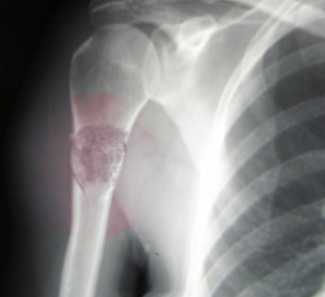 <p>Telangiectactic Osteosarcoma