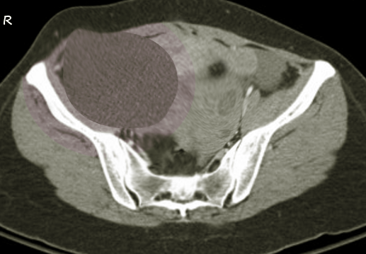 Ovary cystadenoma
