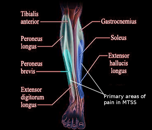 Medial Tibial Stress Syndrome