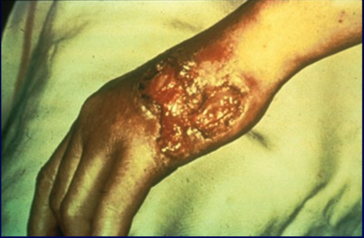 Syphilis gummas lesion