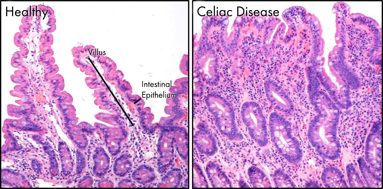 Fig 1: Intestinal changes of Celiac disease. 