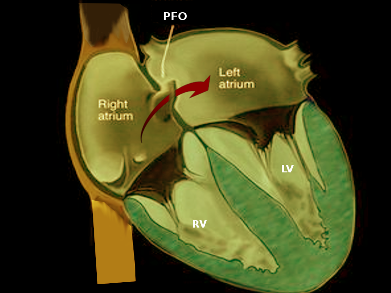 <p>Patent Foramen Ovale