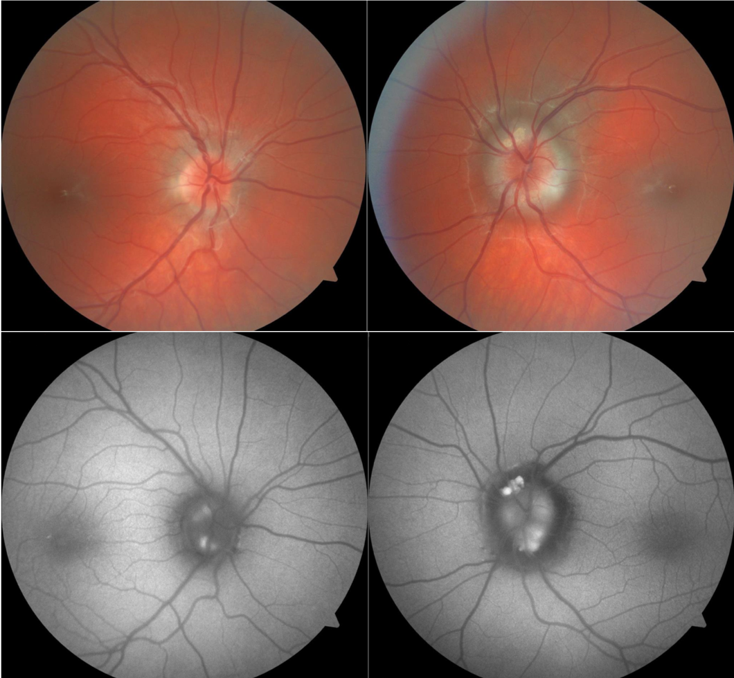 Colour fundus photos of optic nerves with visible optic disc drusen (top)