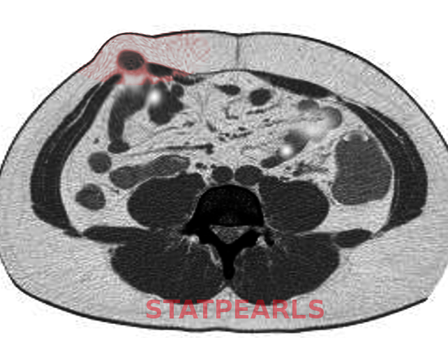 Spigelian hernia