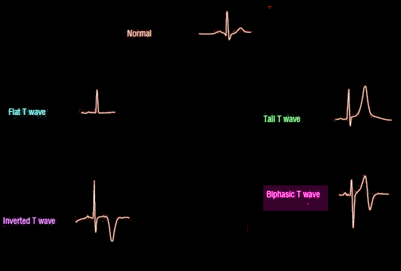 <p>T-Wave Morphology</p>