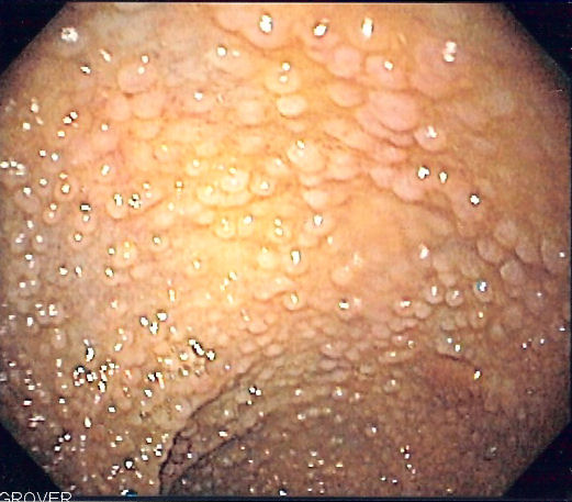 <p>Familial Adenomatous Polyposis. Sigmoidoscopy image revealing numerous polyps.&nbsp;</p>