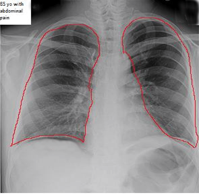 Pneumoperitoneum