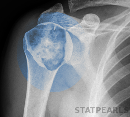 Chondrosarcoma