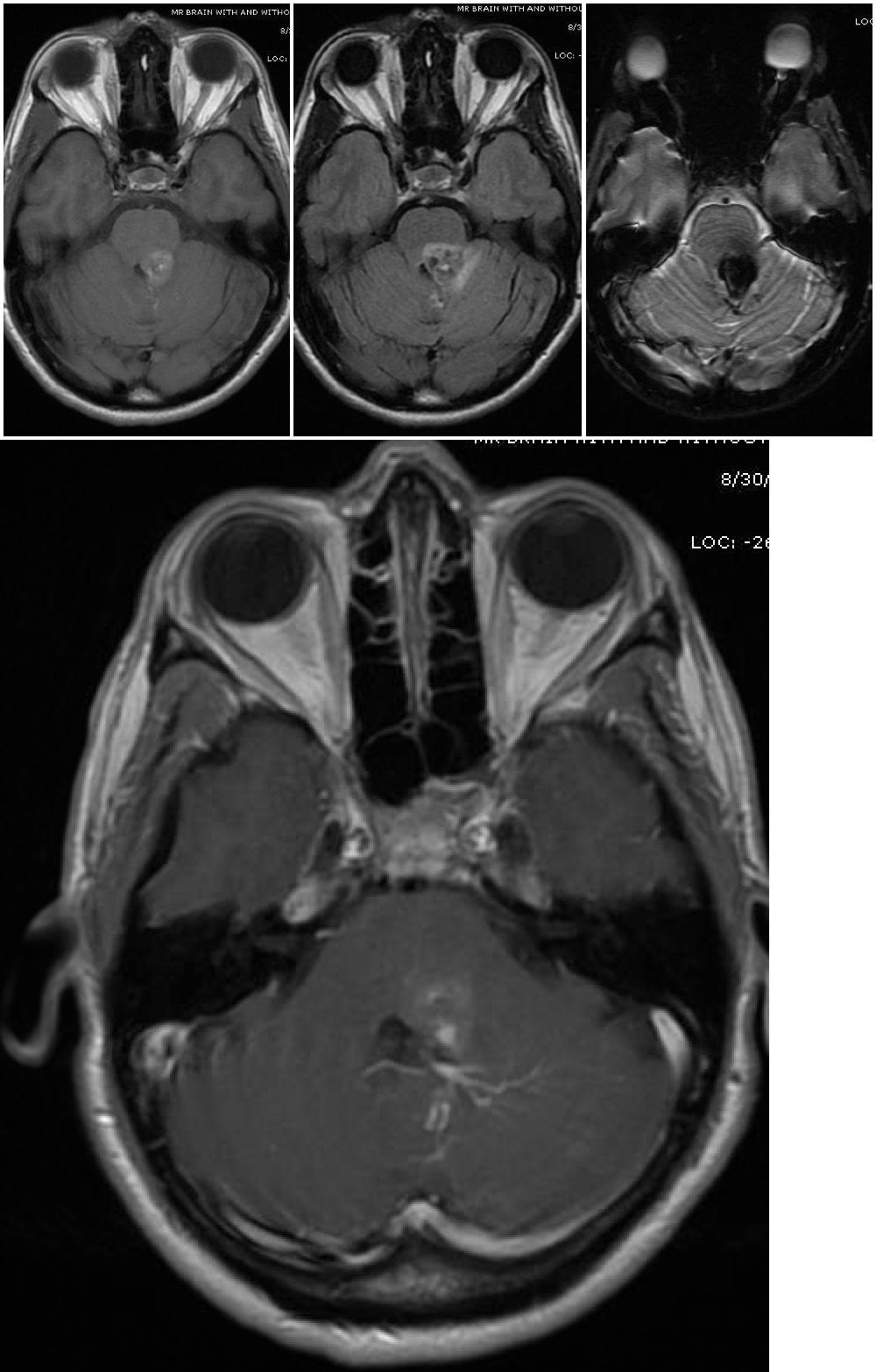 Top three images - Magnetic resonance imaging depicts a cavernous malformation in the left middle cerebellar peduncle of a 42 year old woman who presented with right sided facial numbness and ataxia. Varying signal intensities on T1- and T2-weighted sequences and detection of blood on susceptibility weighted sequences (left, middle, and right images, respectively) that are characteristic for a cavernoma are seen.
Bottom Image - weighted image with contrast enhancement shows a large developmental venous anomaly (DVA) that is associated with the adjacent cavernous malformation. 