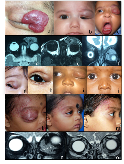 a. Clinical picture showing large superficial hemangioma. 
b,c. Partial and complete obscuration of visual axis due to hemangioma of the upper lid. 
d,e,f. MRI scan axial and coronal view showing homogenous solid pre and post septal soft tissue lesion which is isointense on T1W1 and hyperintense on T2W2 with characterictic flow voids within.
g,h,i,j. Clinical pictures showing partial and complete resolution of upper lid hemangioma with oral propranolol therapy. 
k,l,m. Clinical picture showing CHI at presentation and significant reduction in size and colour of lesion at 3 months and 12 months post treatment with oral propranolol. 
n,o. Pre and post treatment MRI scan showing complete resolution of lesion located along the medial and inferior extraconal space with oral propranolol.

