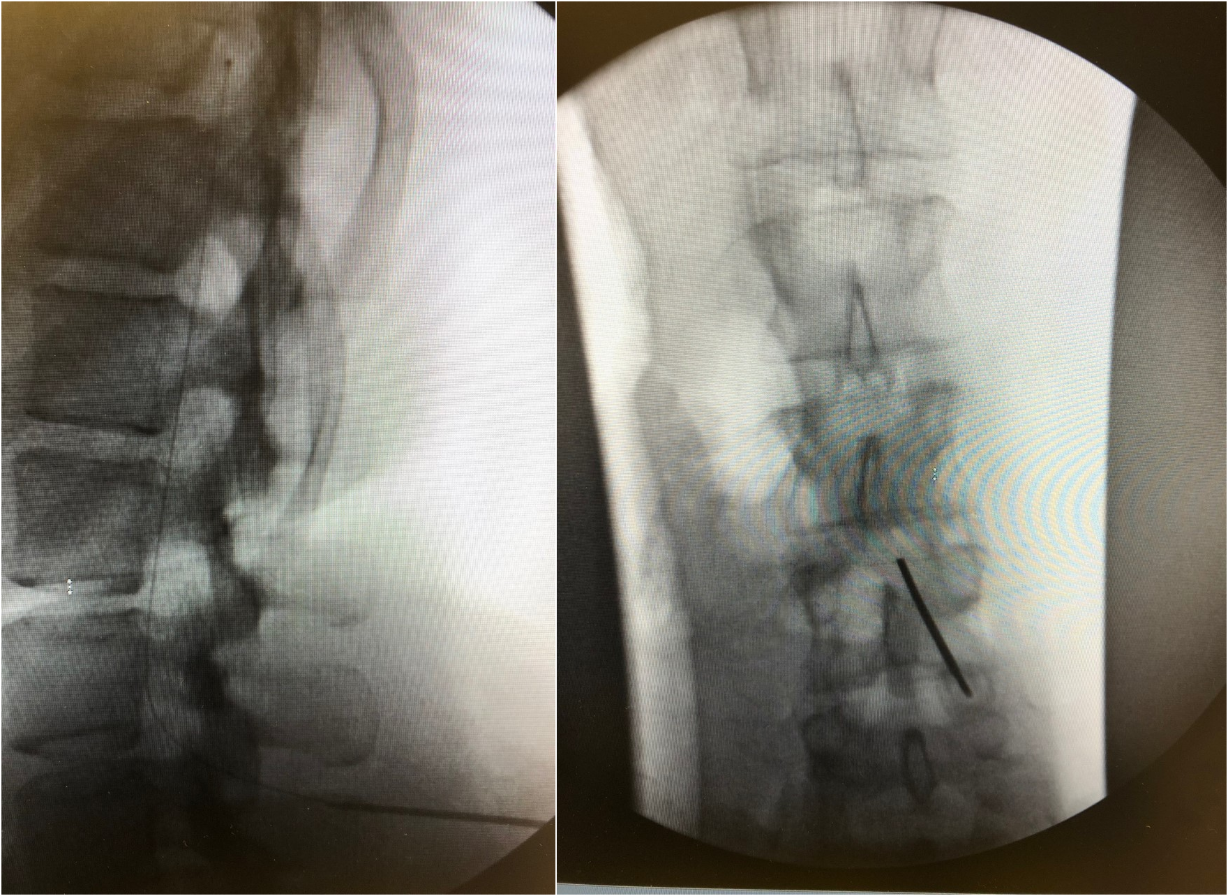 <p>Fluoroscopy, Intrathecal Catheter Placement