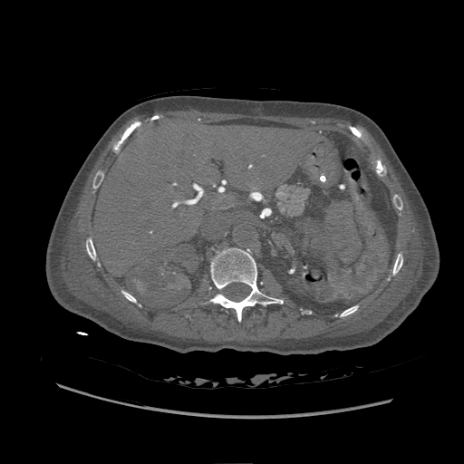 <p>Contrasted Computed Tomography of the Abdomen,&nbsp;Aortic Thrombosis</p>