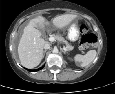 CT scan of pseudomyxoma peritonei showing scalloping of liver and spleen