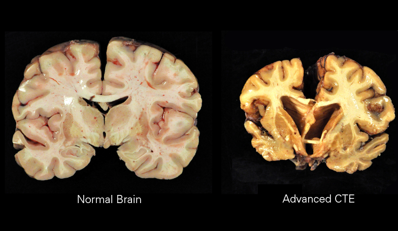 Brain dissections of normal brain (Left) and a brain with stage IV chronic traumatic encephalopathy(Right).  