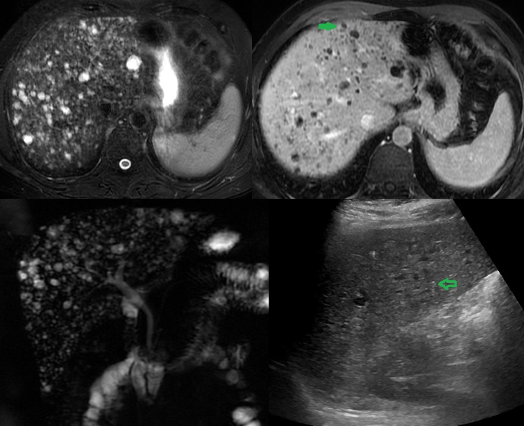 Figure 1. 37-year old female diagnosed as gallstones with acute cholecystitis. The incidental findings ; a: US image show multiple hypoechoic lesions, some of them with comet-tail artifacts, raises the possibility of multiple biliary hamartoma; b: T2-weighted MR image show numerous cystic lesions with signal similar to CSF; c: Post contrast T2 weighted MR image shows some of these lesions with enhancing mural nodule, highly specific for biliary hamartoma; d: MRCP 3D projection image more lesions and demonstrate no communication with normal caliber biliary duct.