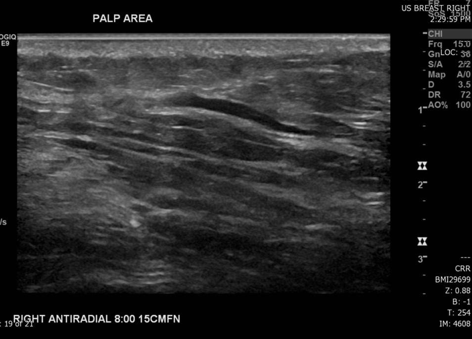 Ultrasound: Gray scale images of the patient's area of palpable concern in the right breast demonstrates a superficial vein with an area of intraluminal thrombus