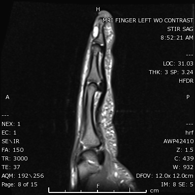 <p>Subungual Mass, STIR Magnetic Resonance Imaging