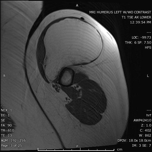 There is a large mass which follows fat signal intensity on this T1 non fat saturated axial MRI image of the left humerus