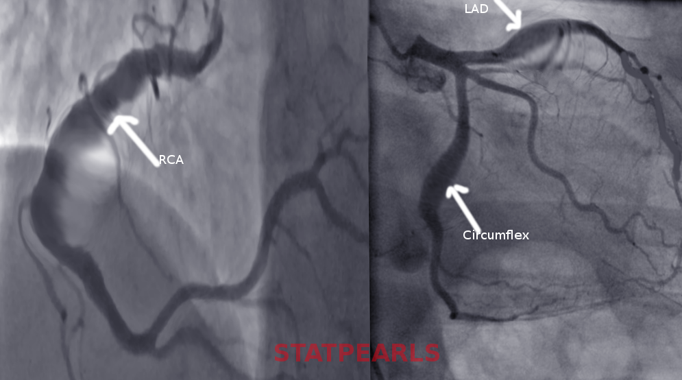 <p>Coronary Artery Ectasia, Angiograph. The image shows coronary artery ectasia, a dilation of the coronary artery lumen.</p>