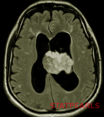 Choroid plexus papilloma