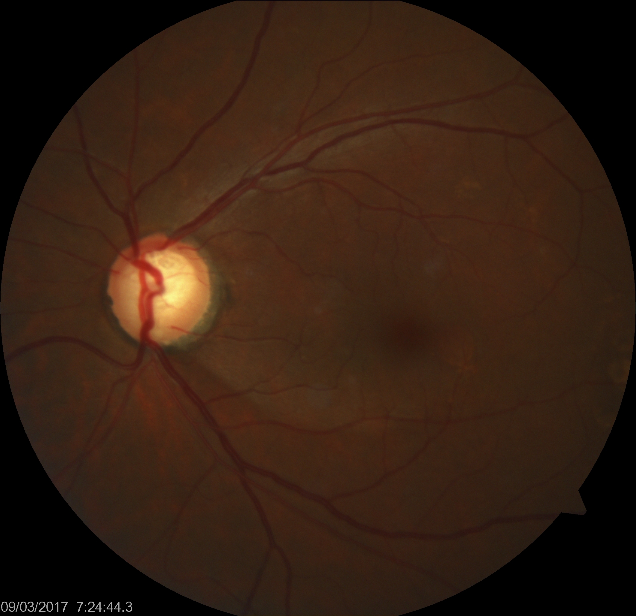 Glaucomatous optic nerve head with inferotemporal retinal nerve fiber layer defect