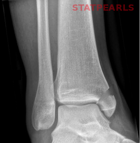 Ankle fracture